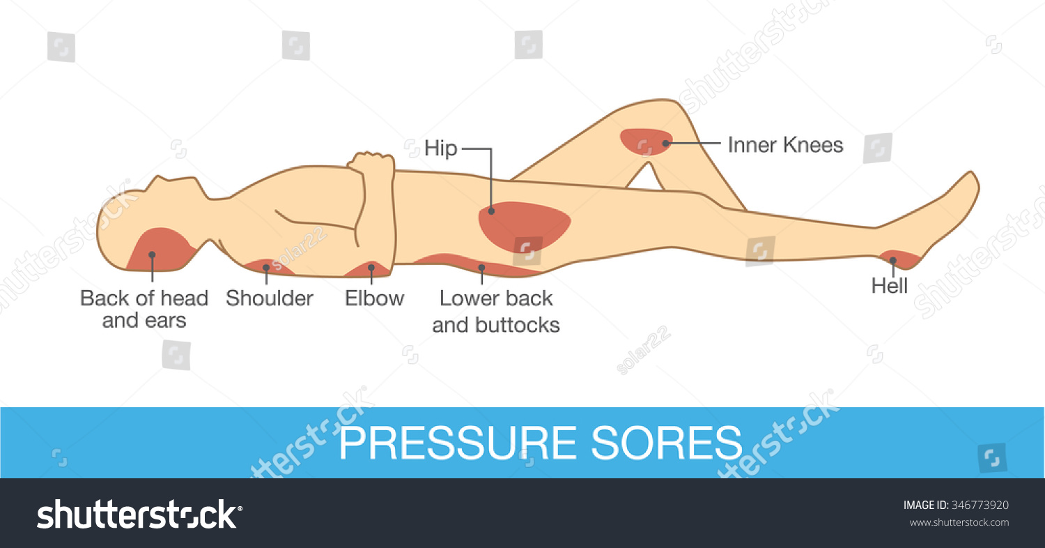 pressure-sore-images-stock-photos-vectors-shutterstock