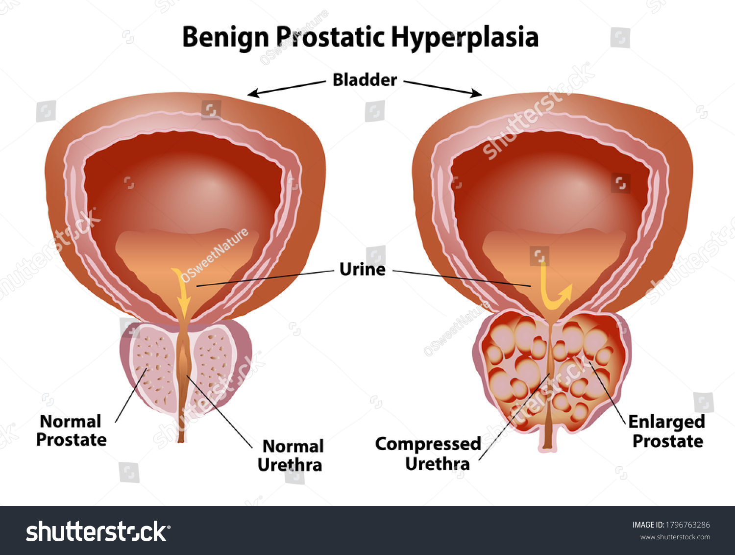 Prostate Normal Enlarged Benign Prostatic Hyperplasia Stock Vector 8631