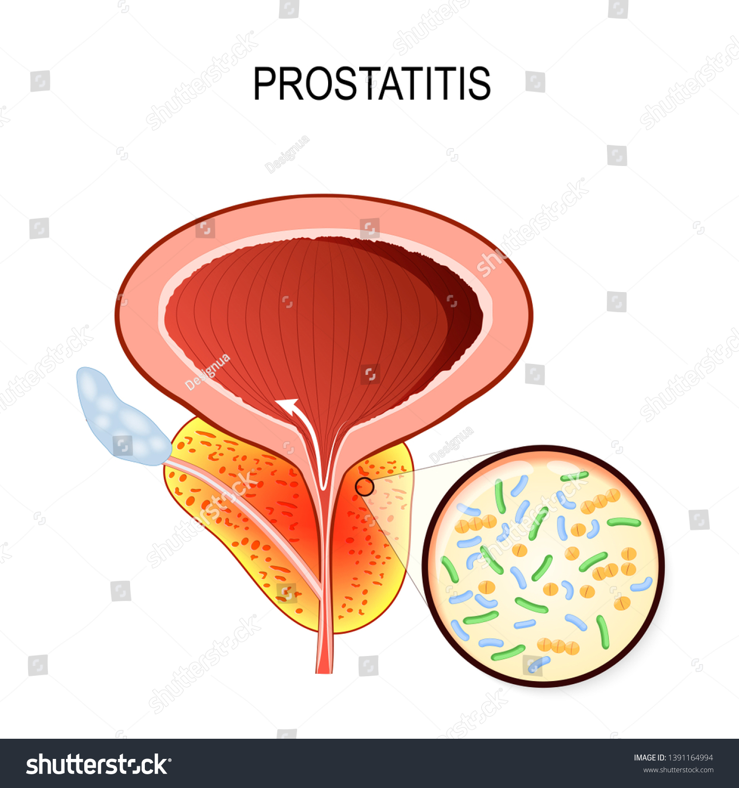 Prostatitis Closeup Bacteria That Cause Inflammation Stock Vector Royalty Free Prostatitis Closeup Bacteria That Cause Inflammation Stock Vector Royalty Free