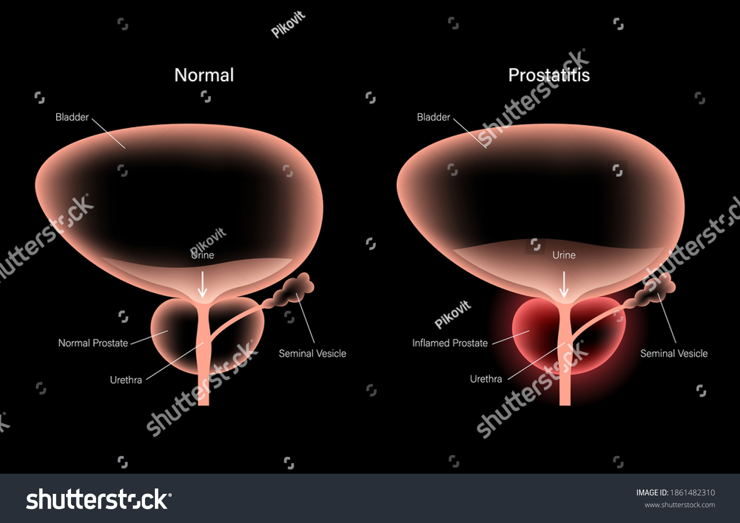 Prostatitis Swelling Inflammation Prostate Gland Normal: Vetor Stock ...