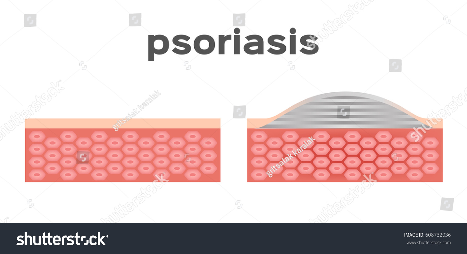 Psoriasis Skin Vector Stock Vector (Royalty Free) 608732036