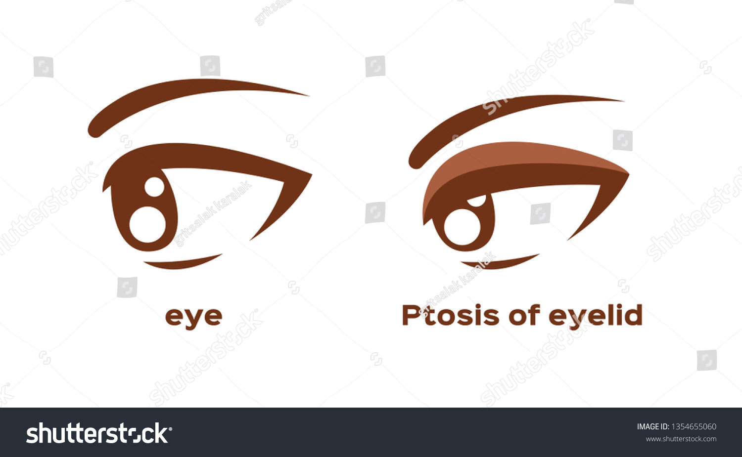 Ptosis Eyelid Eye Sickness Anatomy Vector Stock Vector (Royalty Free ...