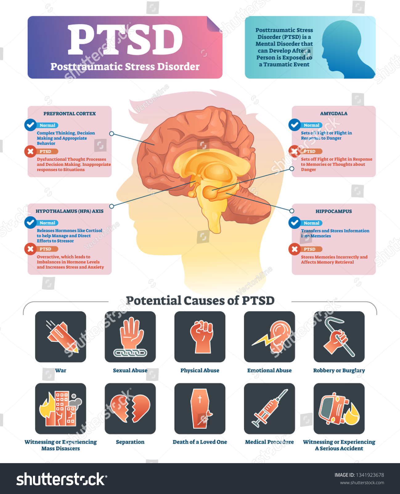 SVG of PTSD vector illustration. Labeled anatomical mental disorder causes scheme. Compared healthy and problematic brain differences set. Explained psychiatry diagnosis after disasters, abuse and accidents. svg