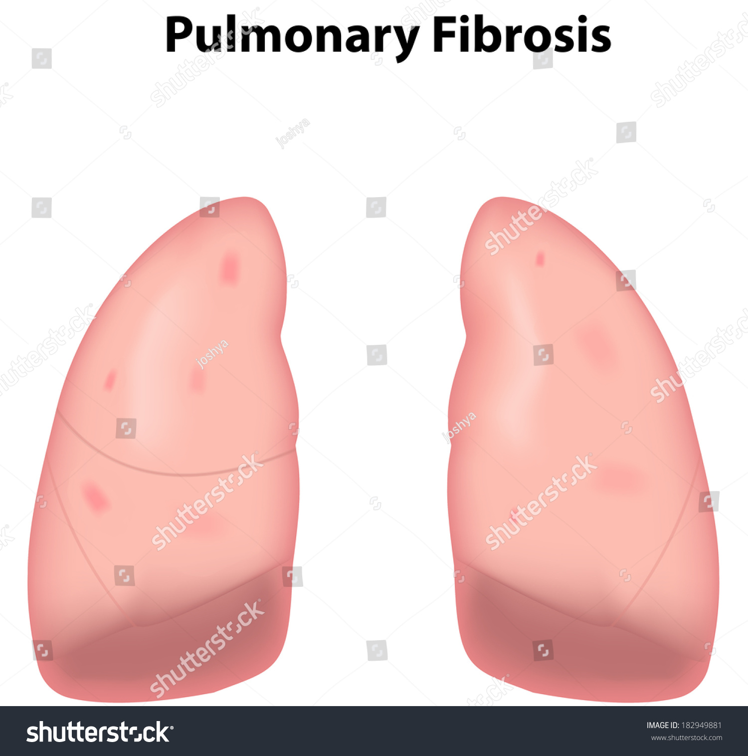 Pulmonary Fibrosis Stock Vector (Royalty Free) 182949881 | Shutterstock