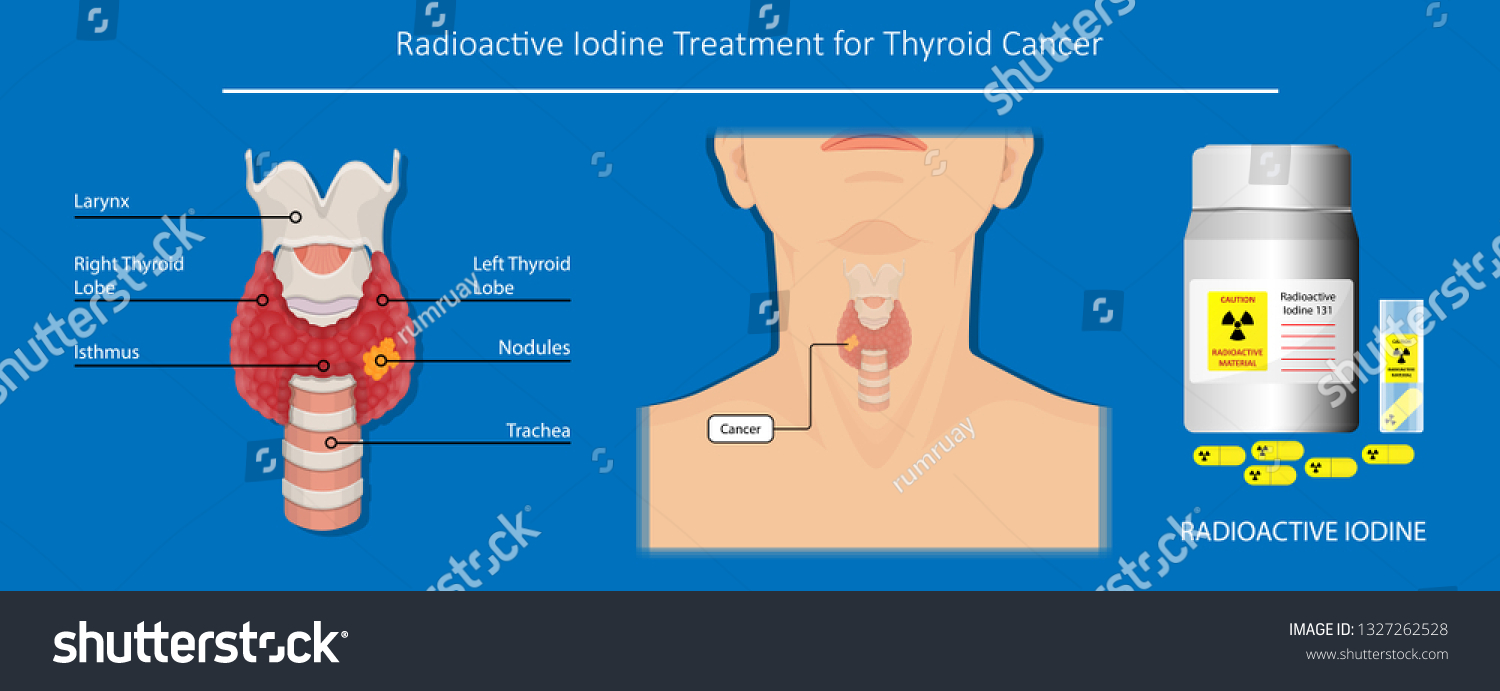iodine treatment for thyroid