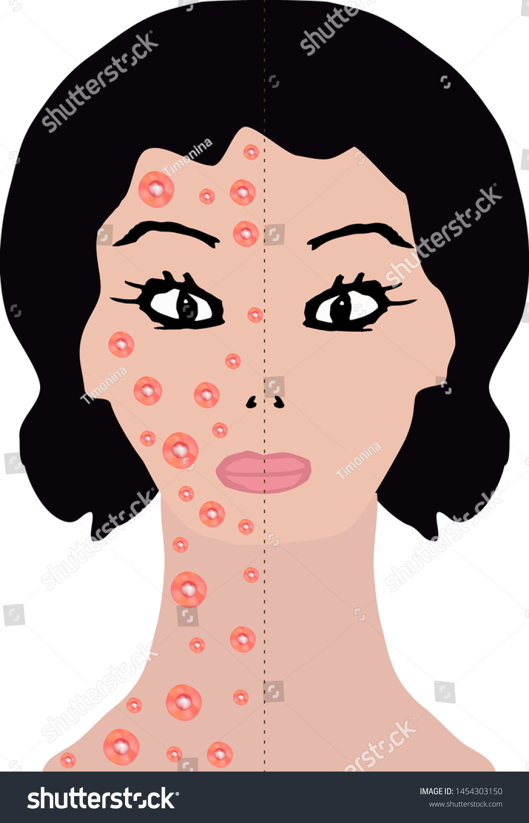 Rash On Half Face Neck Allergy Stock Vector Royalty Free 1454303150