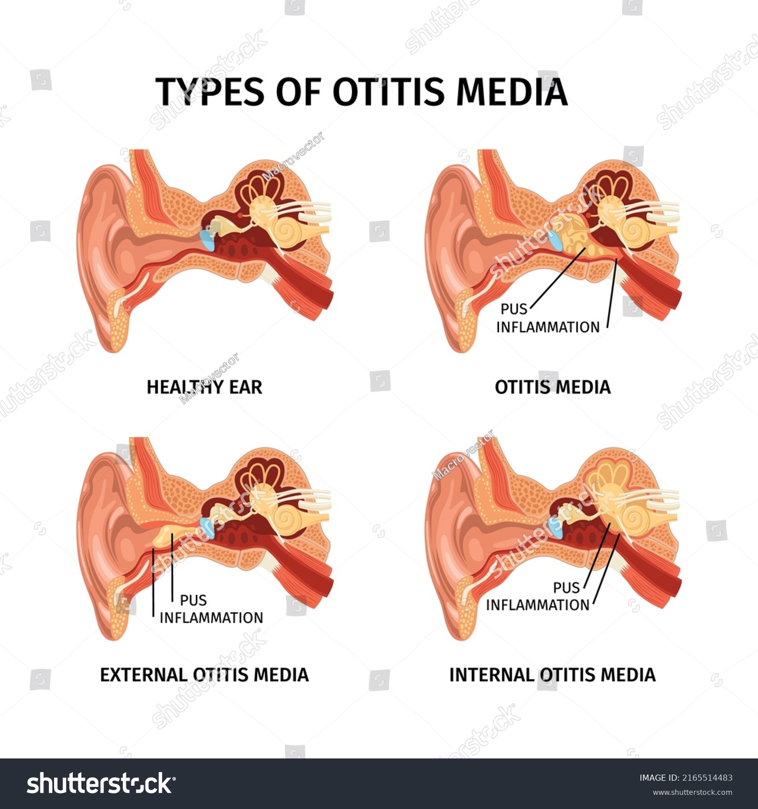 Realistic Anatomy Ear Otitis Set Four Stock Vector (Royalty Free ...