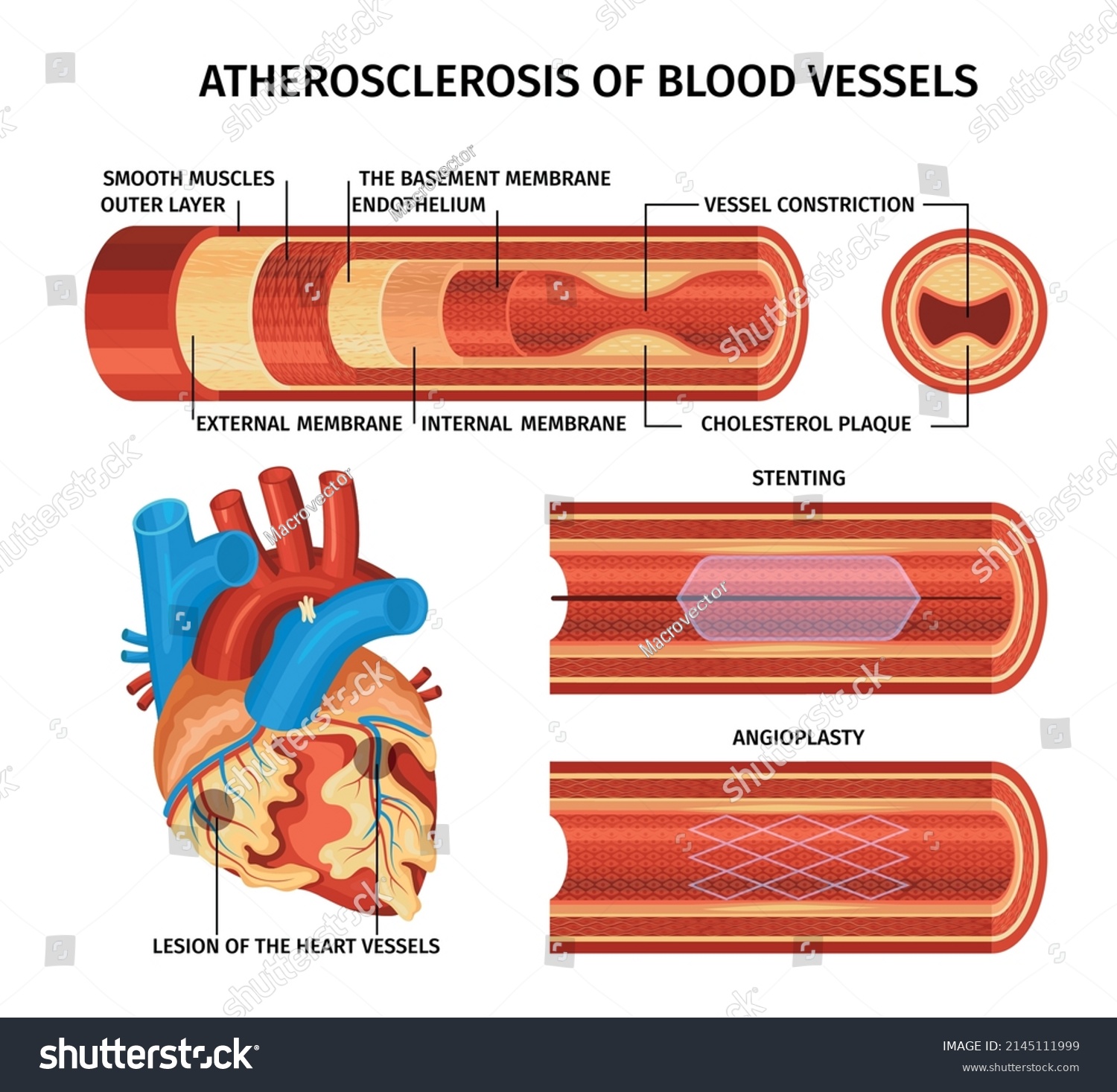 Realistic Atherosclerosis Infographic Stenting Angioplasty Descriptions ...