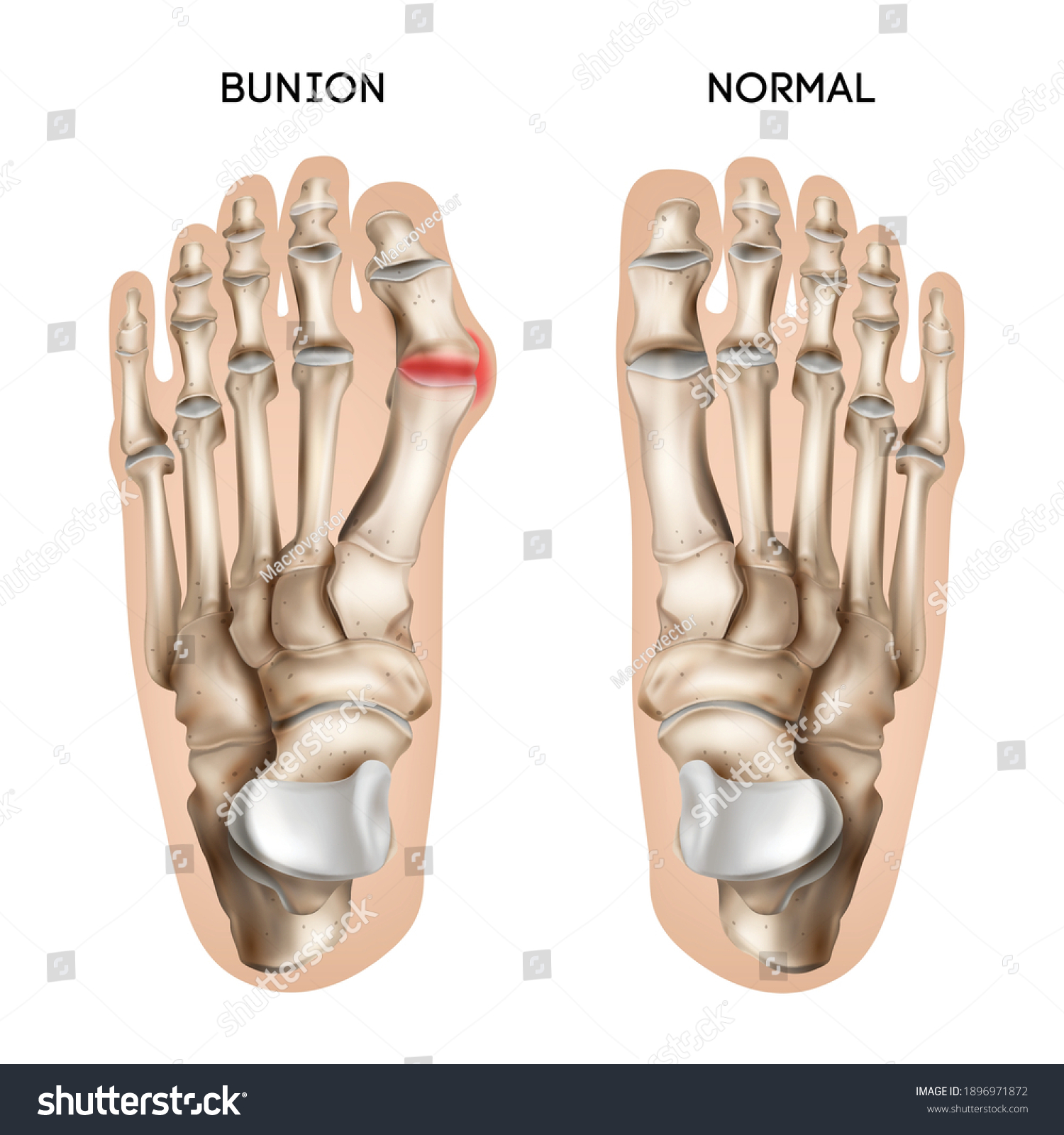 426 Bunions illustration Images, Stock Photos & Vectors | Shutterstock