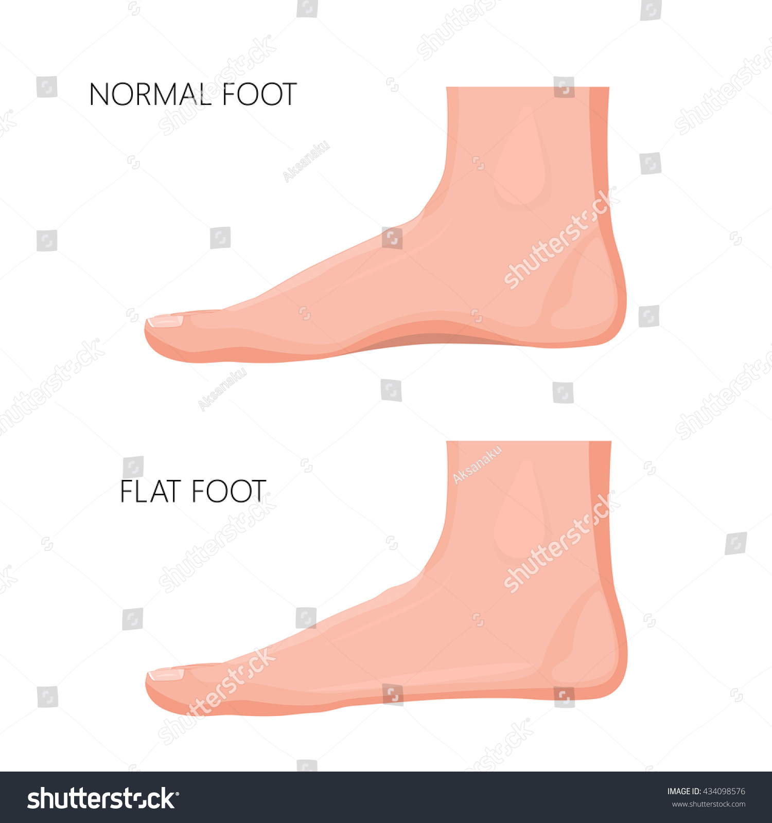 Realistic Illustration Normal Foot Flat Foot Stock Vector 434098576 ...