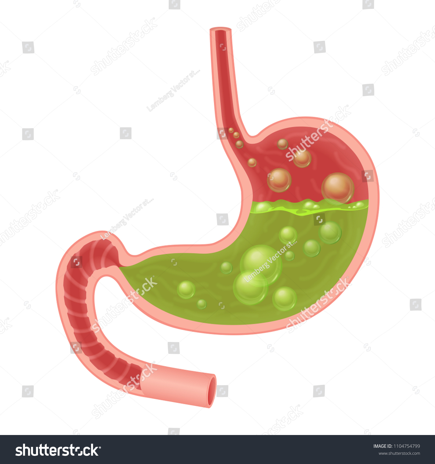 吐き気胃のリアルな医療イラスト 胃の中の緑色の液体 のベクター画像素材 ロイヤリティフリー