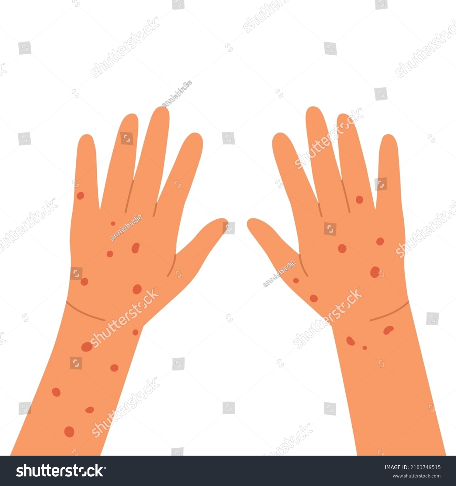 Red Rash On Hands Allergy Dermatitis Stock Vector (Royalty Free ...