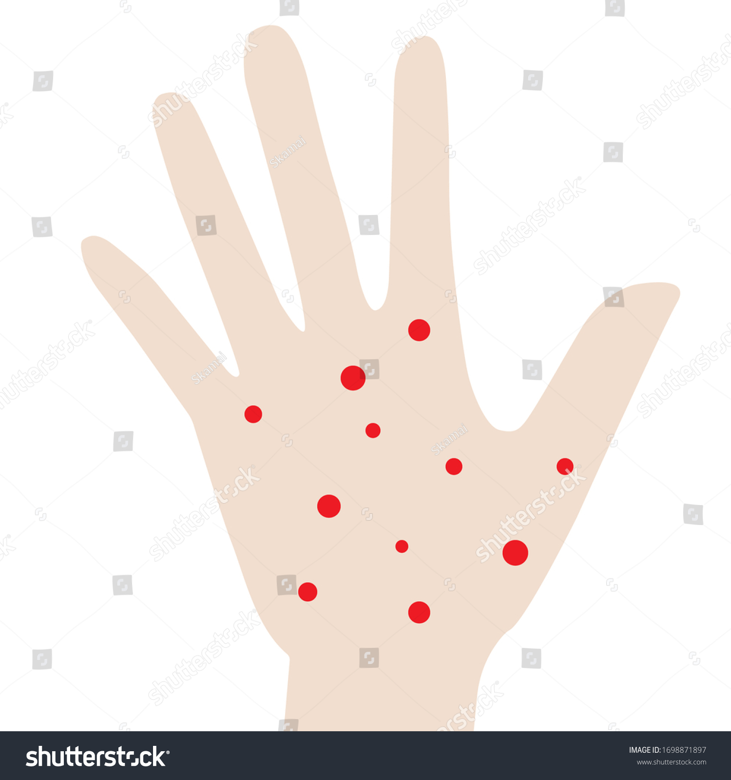 Red Spots On Hand Light Skin Stock Vector (Royalty Free) 1698871897