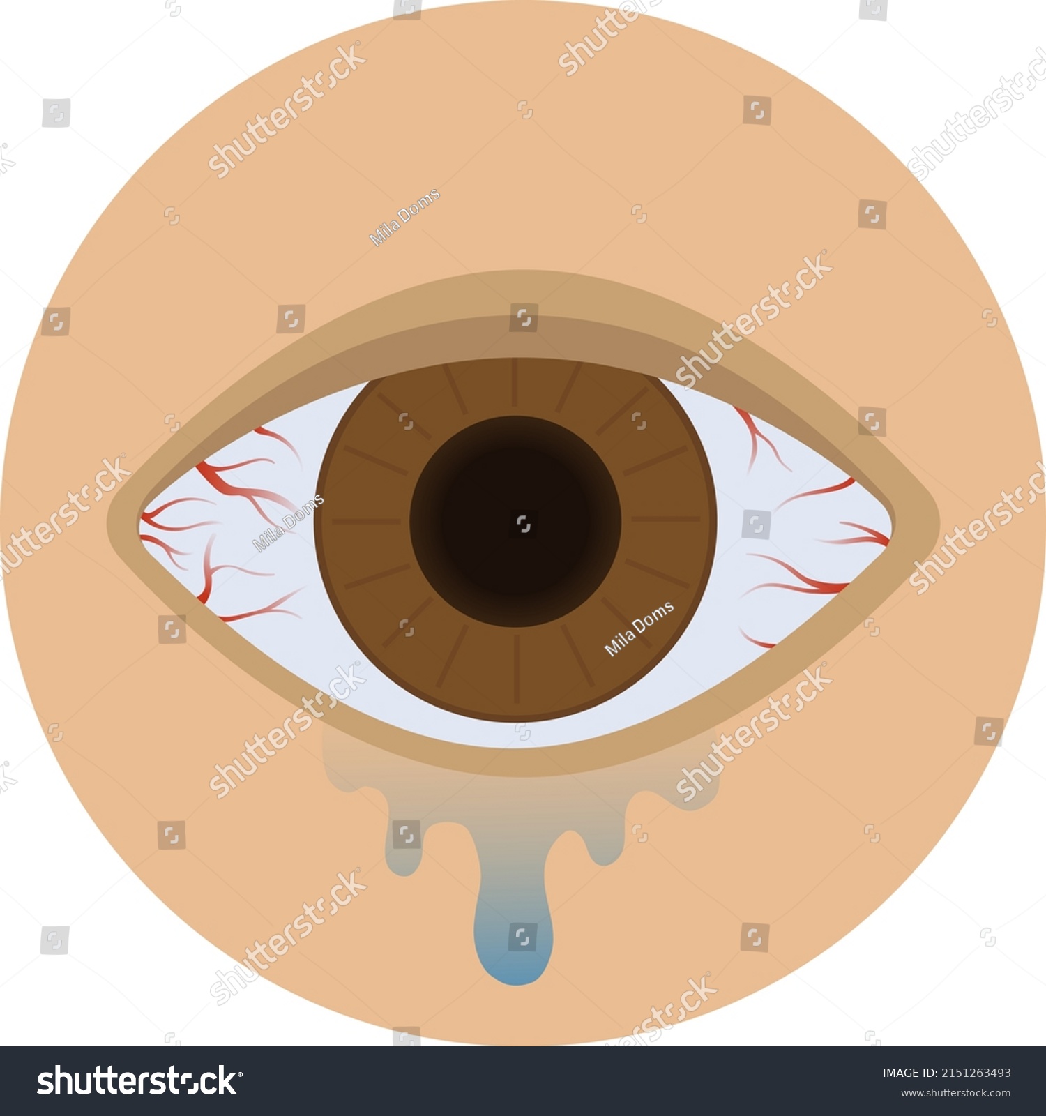 Redness Eyes Tearing Conjunctivitis Humans Conjunctivitis Stock Vector