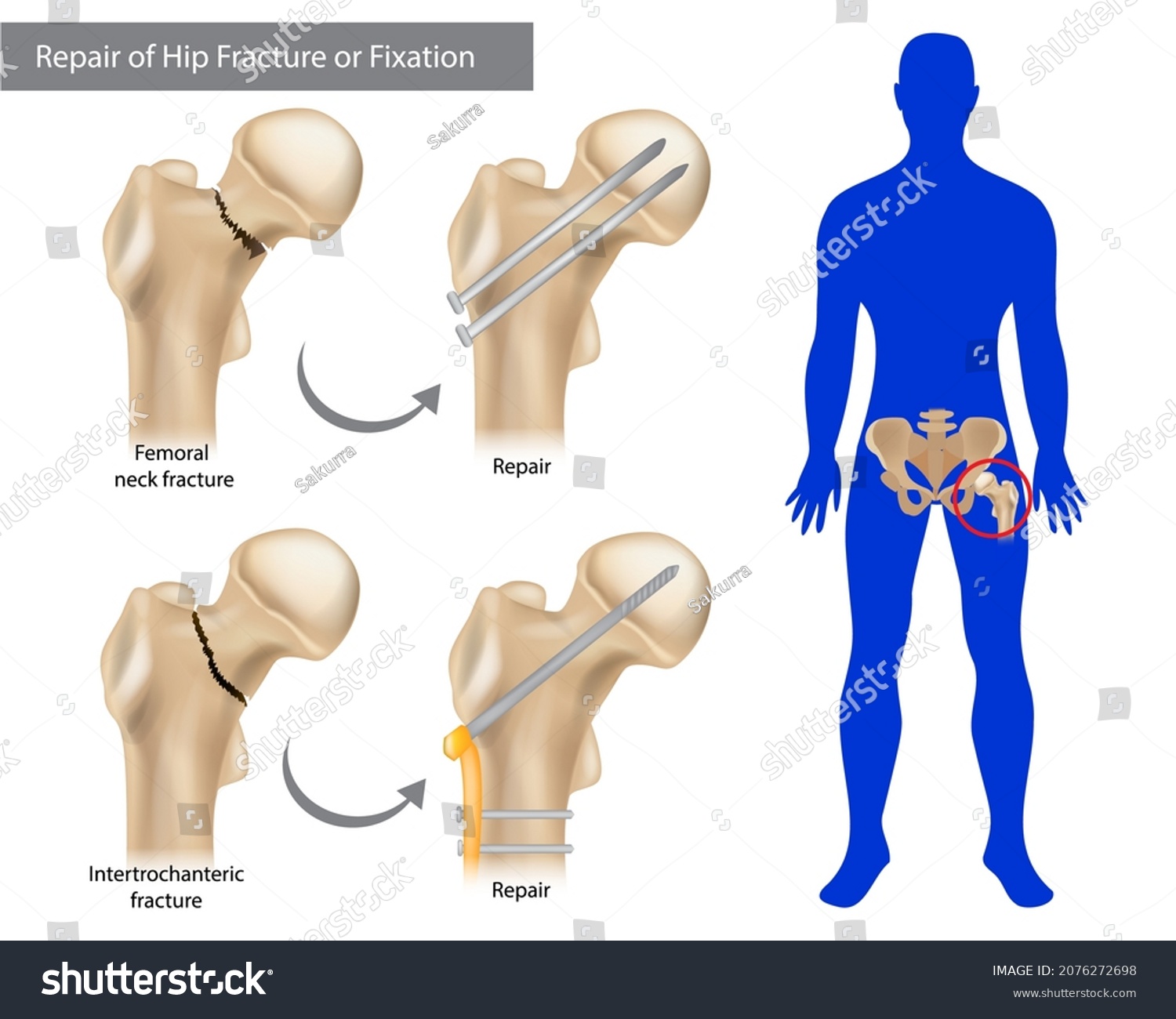 SVG of Repair of Hip Fracture or Fixation. Intertrochanteric fracture or Femoral neck fracture. Broken Hip svg