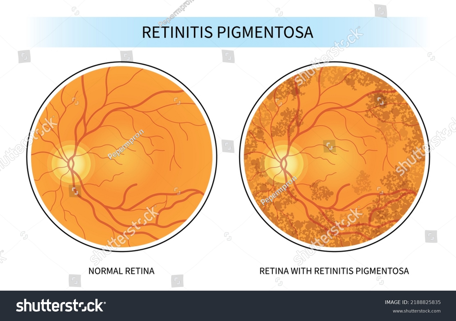 SVG of retinal degenerative and Blurry vision of Age related Blind spots with cone rod dystrophy svg