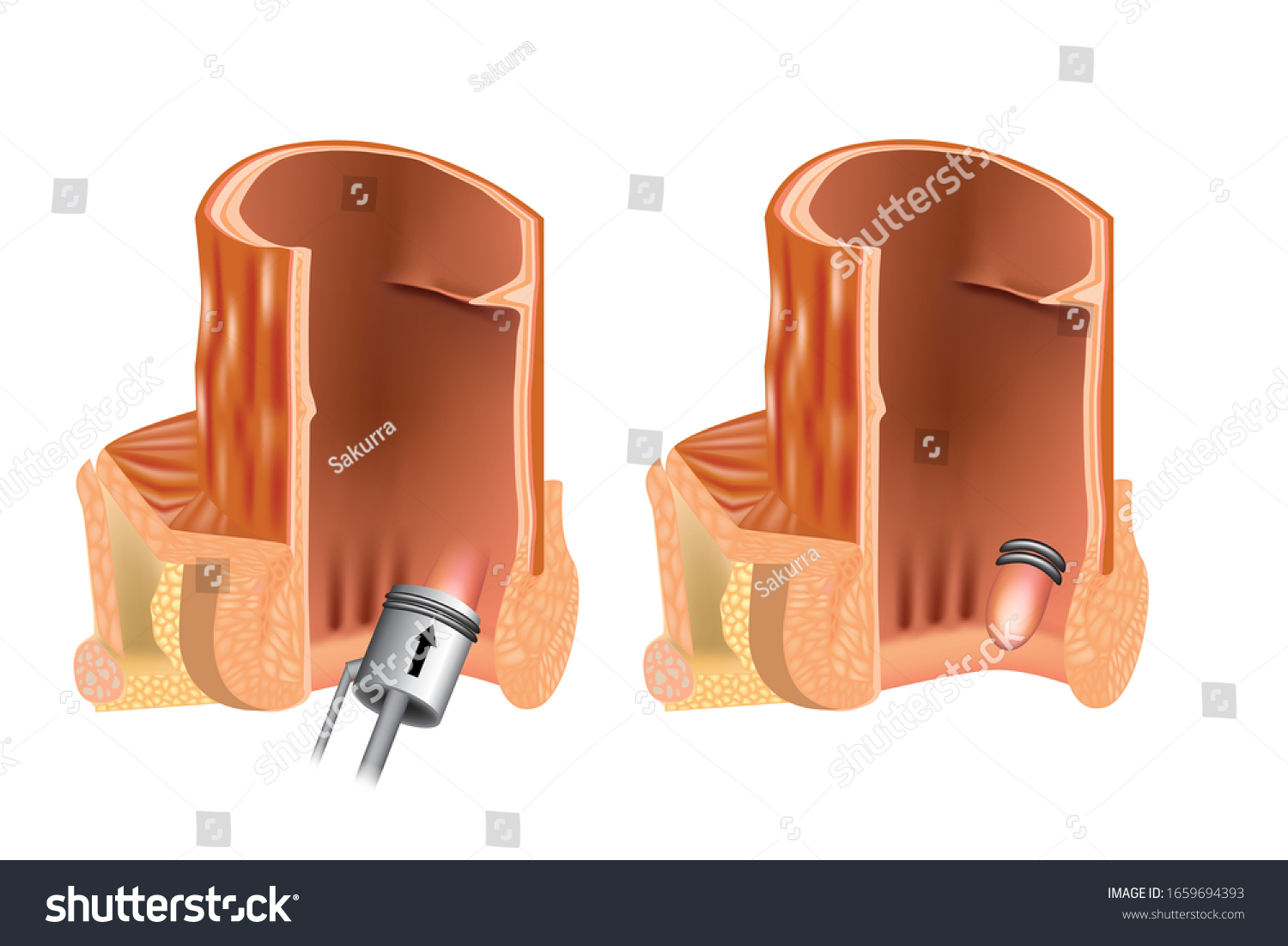 72 Rubber Band Ligation Images Stock Photos Vectors Shutterstock   Stock Vector Rubber Band Ligation Of Hemorrhoid Latex Ligation Rbl Anoscope 1659694393 