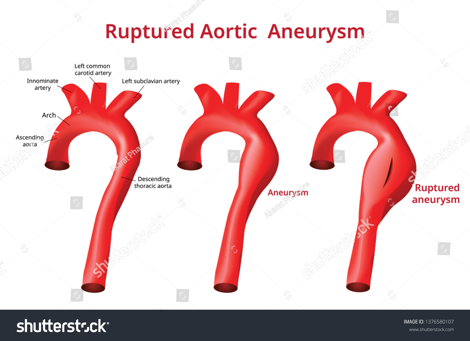 Vektor Stok Ruptured Aortic Aneurysm Aortic Disease Vector Tanpa Royalti 1376580107 Shutterstock 0275