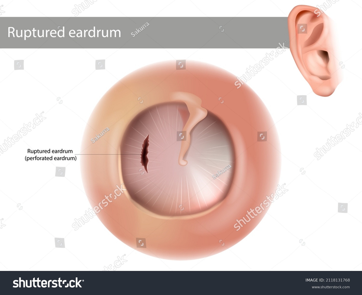 Tambour d'oreille en rupture ou tympan image vectorielle de stock