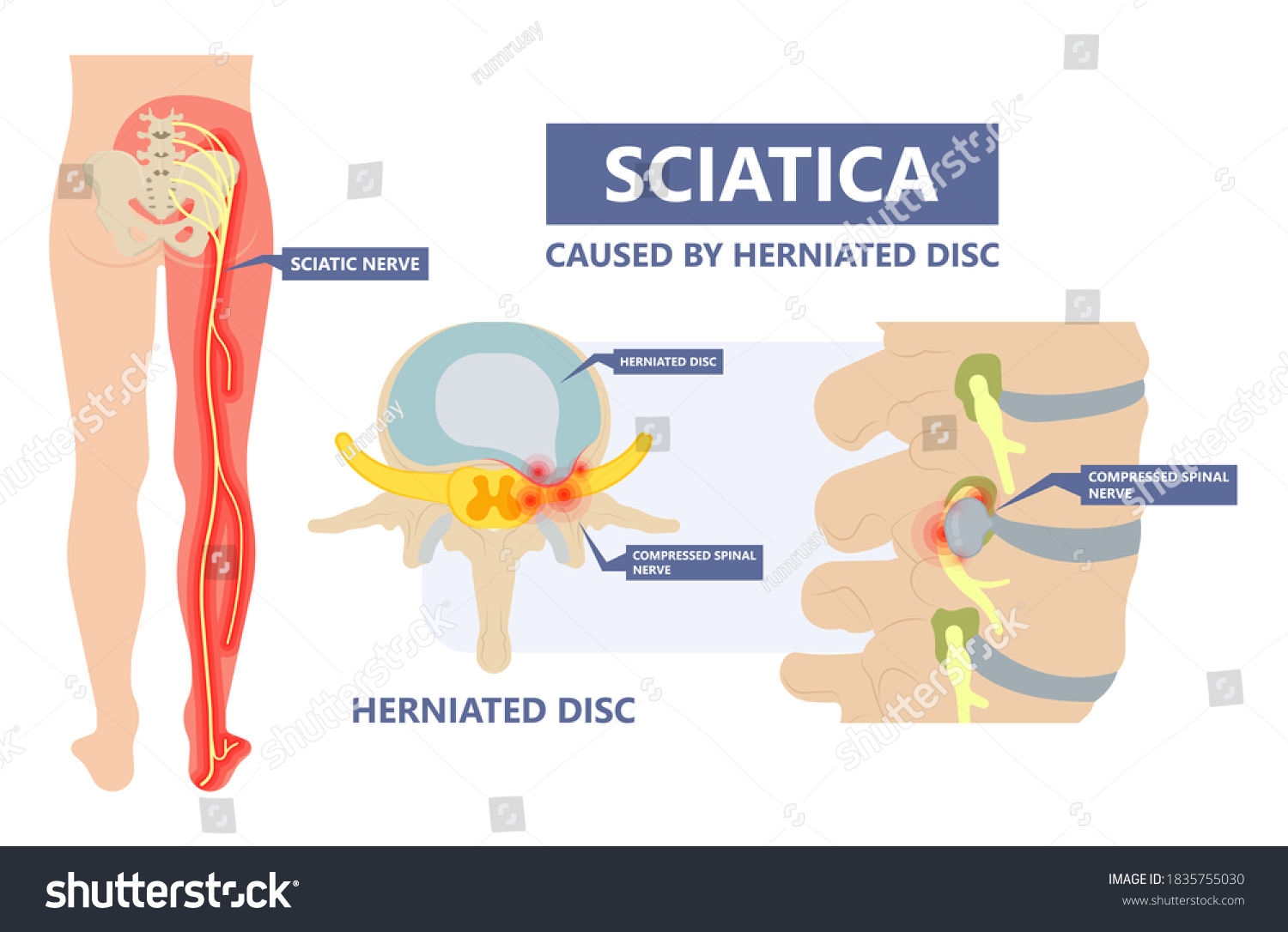 Sciatica Nerve Pain Lower Back Through Stock Vector Royalty Free 1835755030