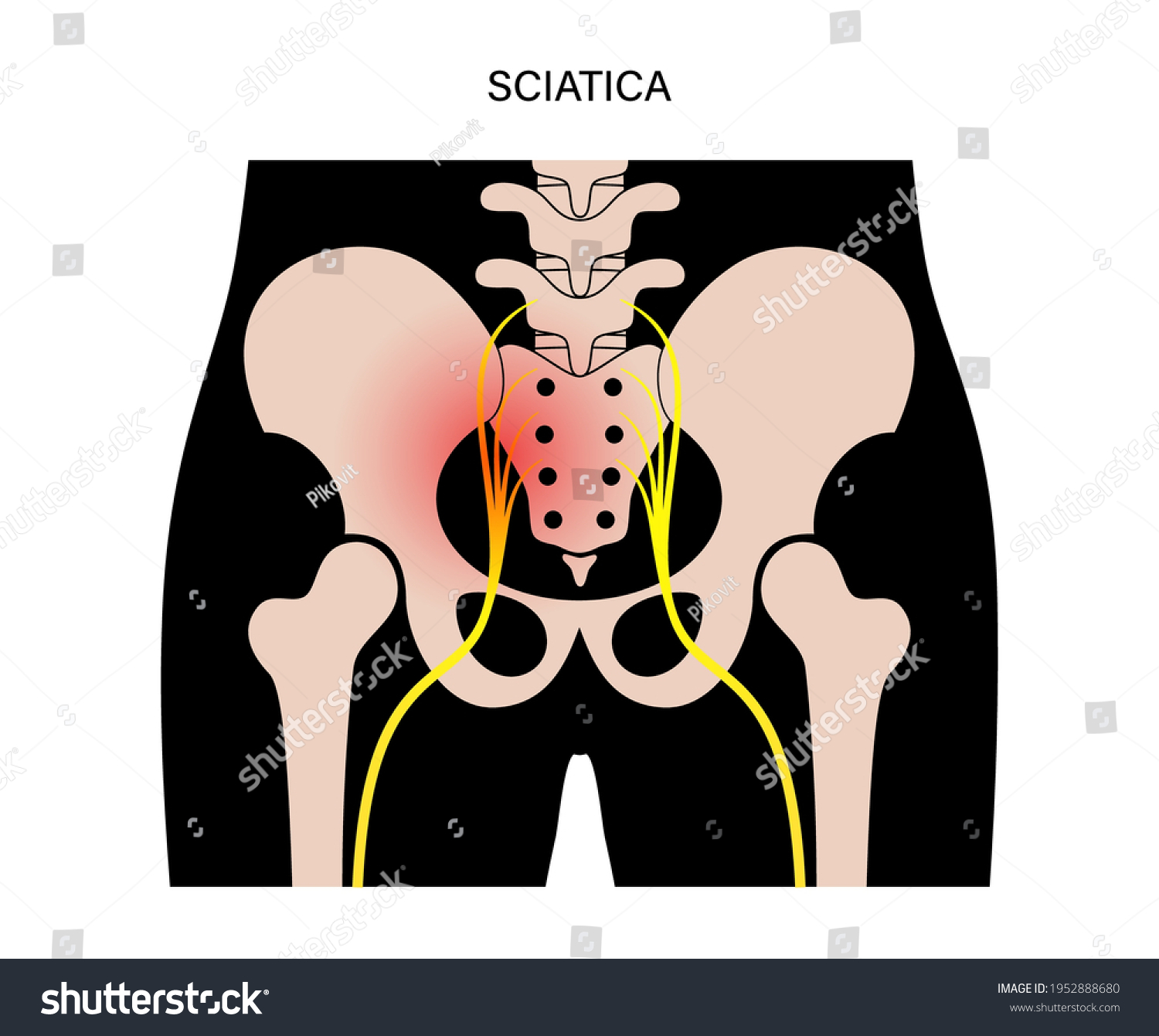 Sciatica Pain Inflammation Pelvis Leg Hip Stock Vector (Royalty Free ...