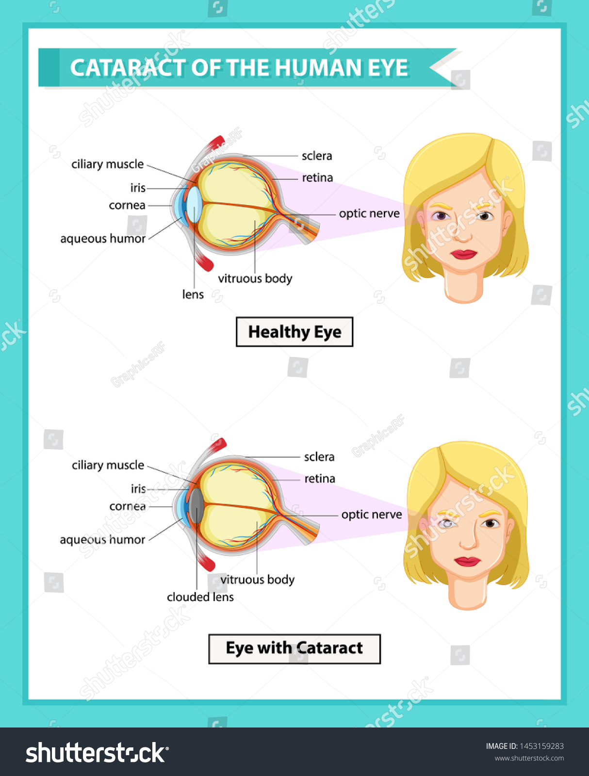 Scientific Medical Illustration Cataract Human Eye Stock Vector Royalty Free 1453159283 6506