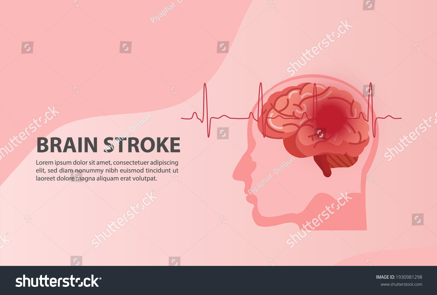 Scientific Medical Illustration Human Brain Stroke Stock Vector Royalty Free 1930981298 5555