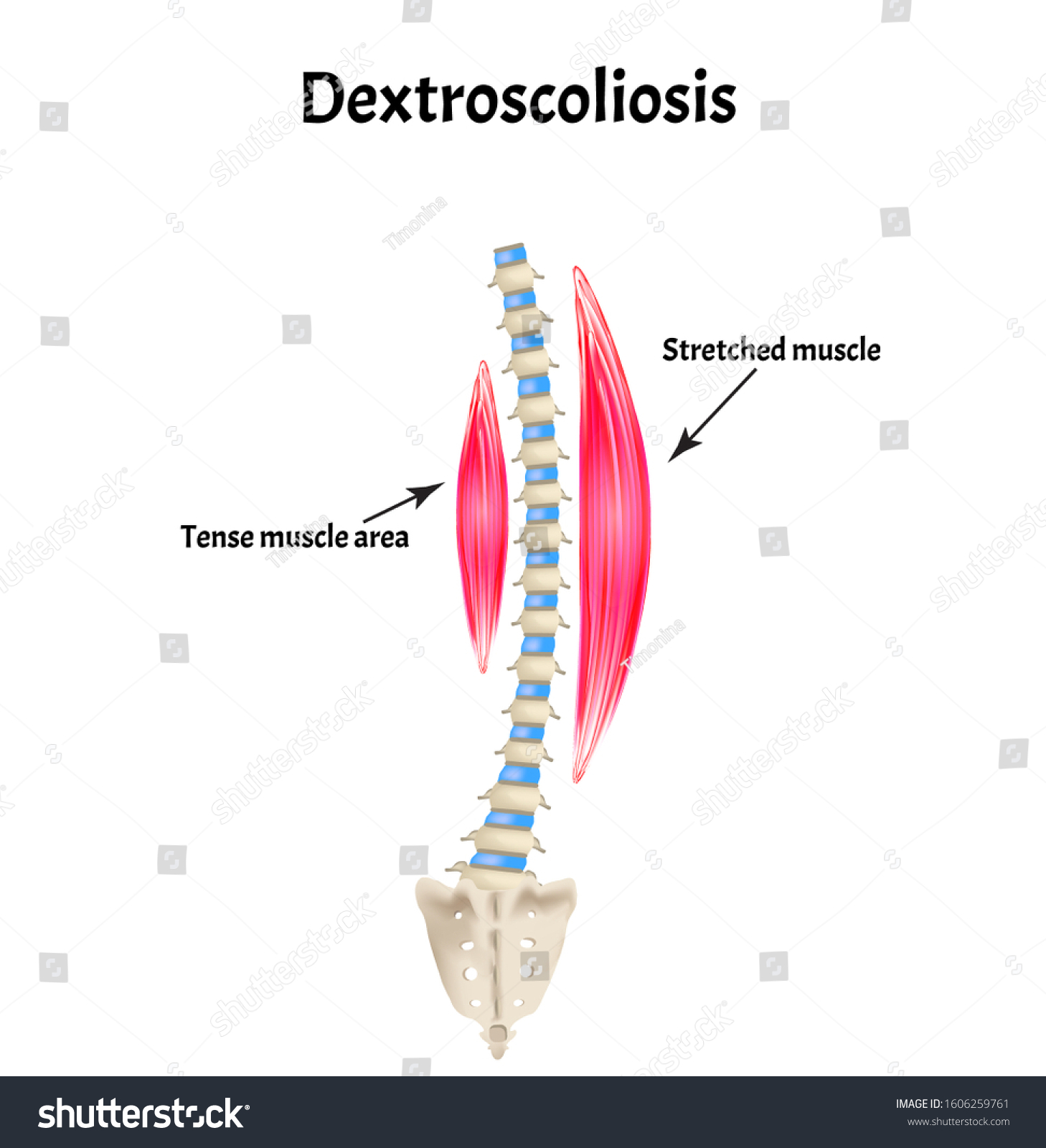 Scoliosis Dextroscoliosis Spinal Curvature Kyphosis Lordosis Stock Vector Royalty Free