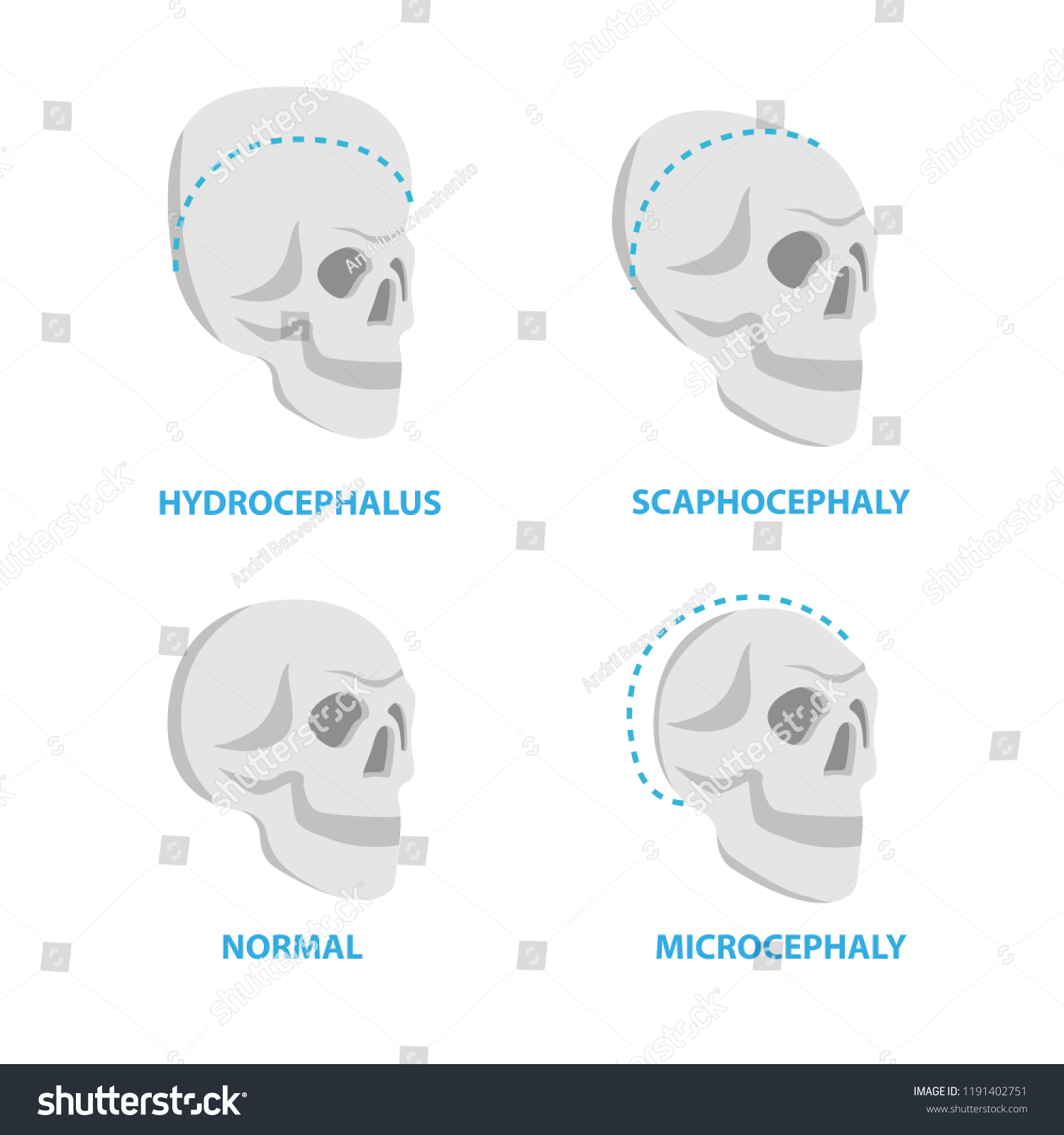 SVG of Set of Skulls normal and deformed,  hydrocephalus, scaphocephaly, microcephaly vector flat icons, skull medical illustrations, anatomical infographic elements isolated on white background. svg