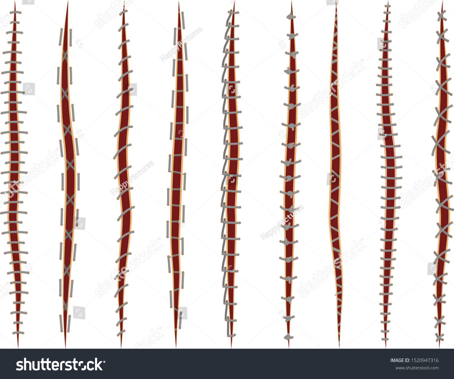 Set Different Illustrations Medical Stitches Injury Stock Vector ...