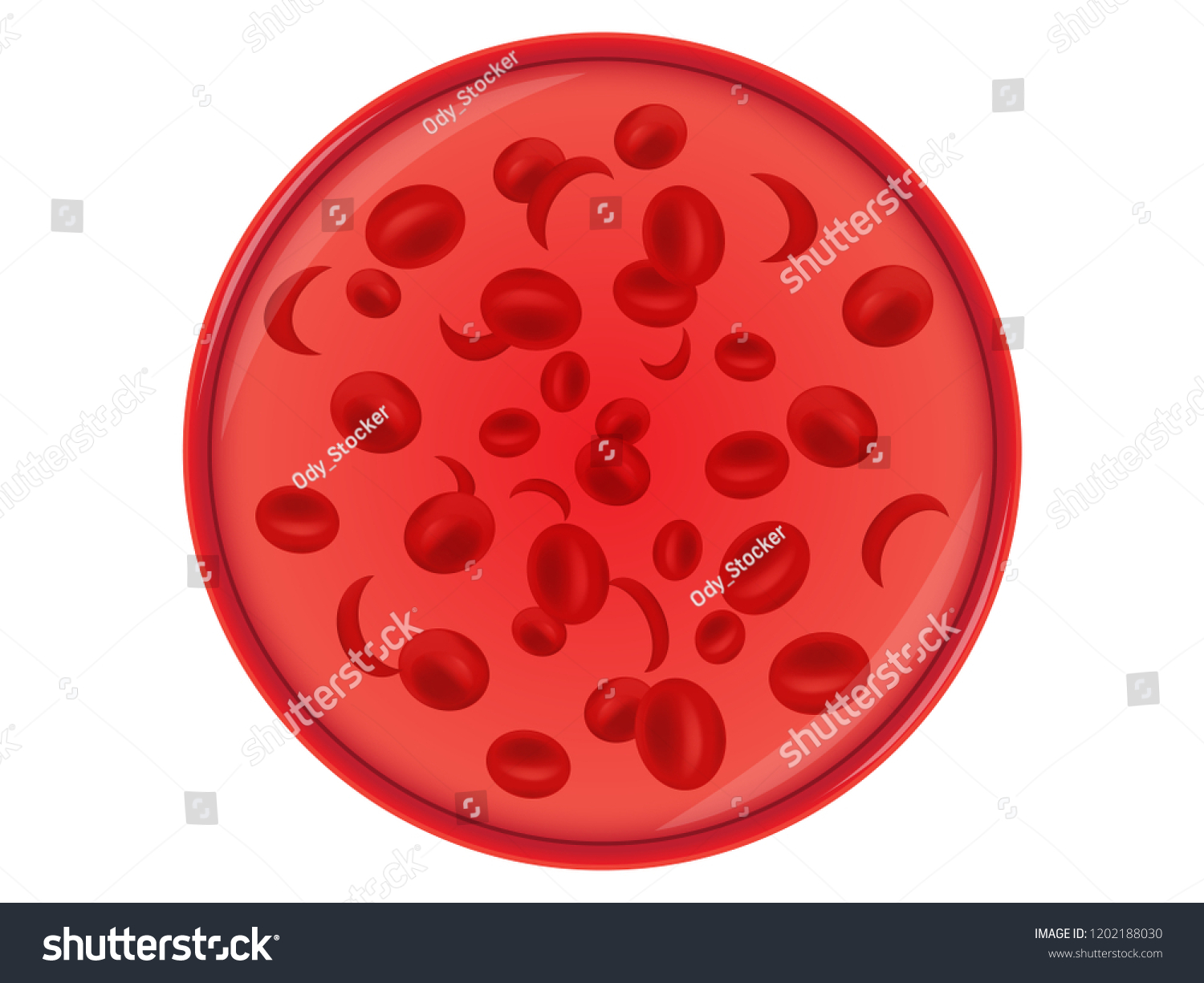 Sickle Cell Anemia Genetic Diseases Stock Vector (Royalty Free ...