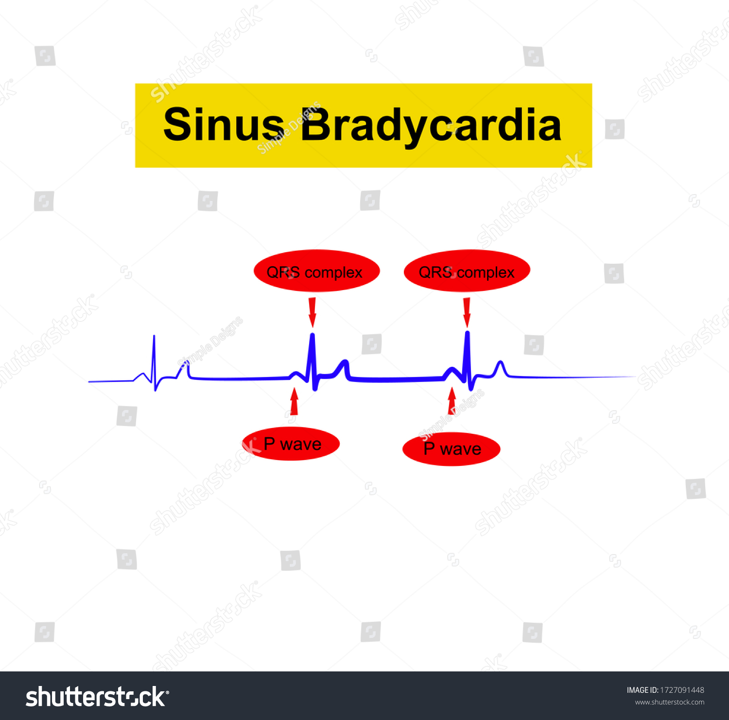 Sinus Bradycardia Ecg Heart Rate Slower Stock Vector Royalty Free
