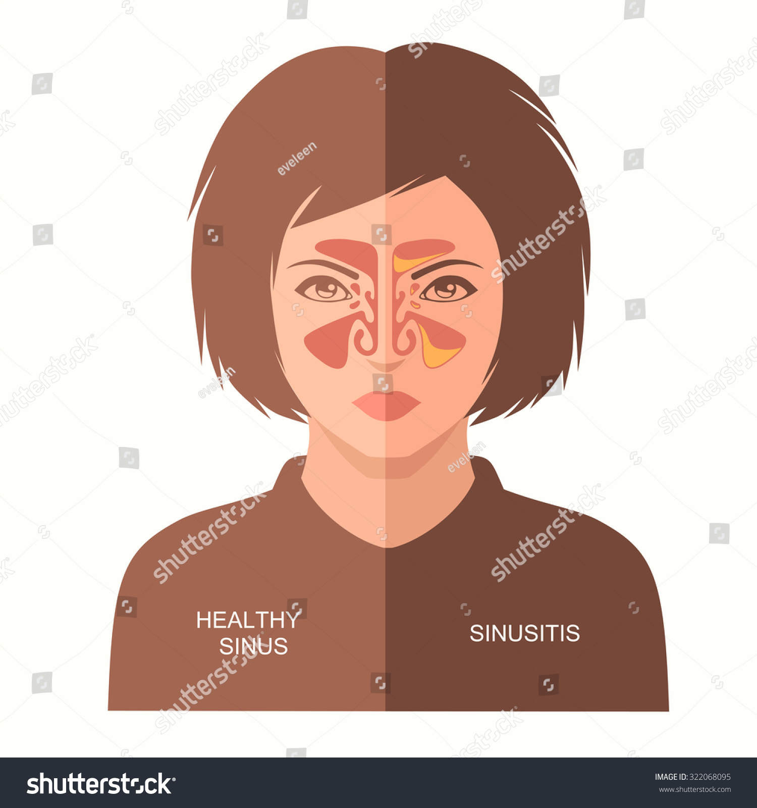 Vektor Stok Sinusitis Disease Vector Nose Illustration Sinus Tanpa Royalti 322068095