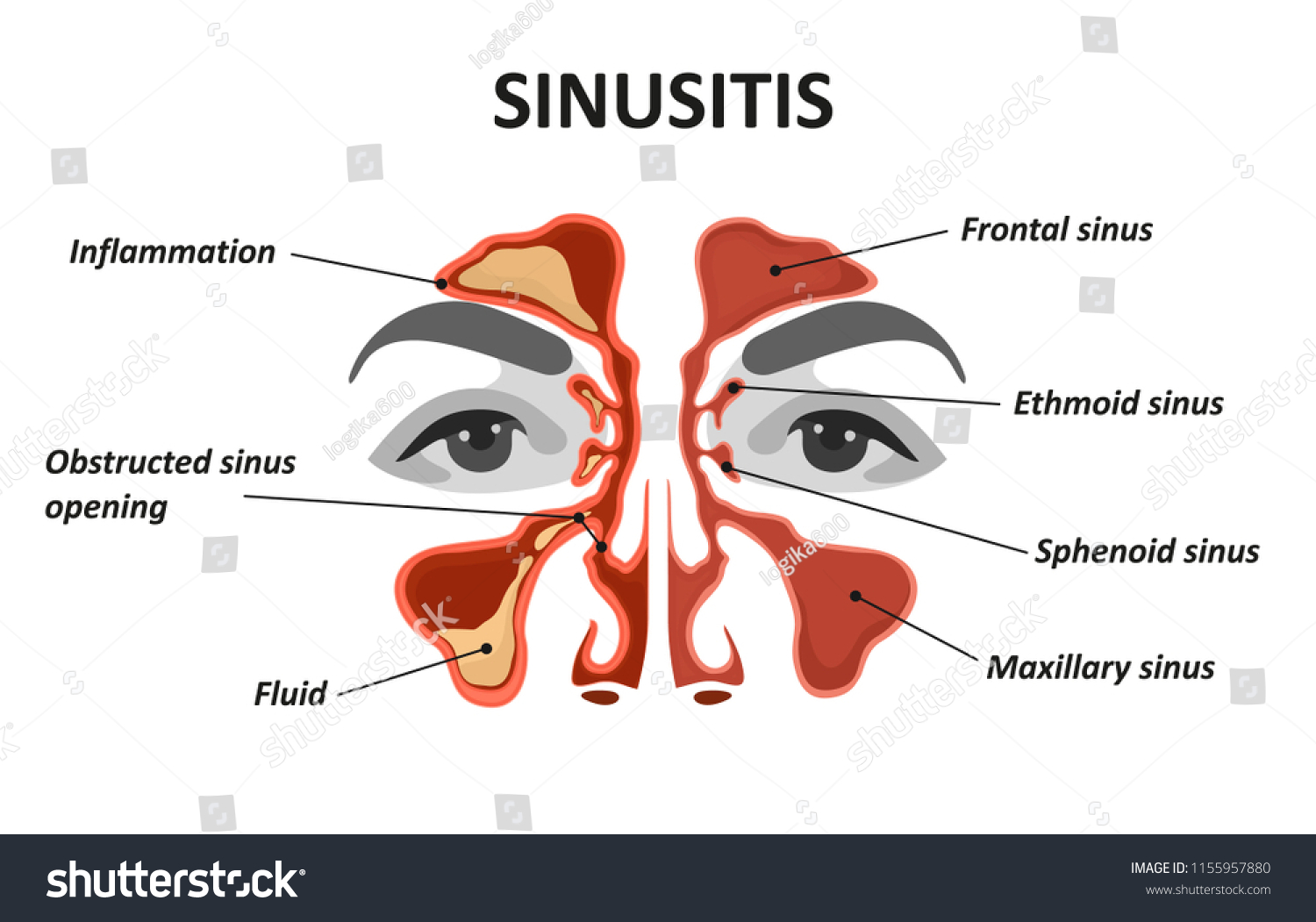 1-359-sinus-infection-stock-vectors-images-vector-art-shutterstock