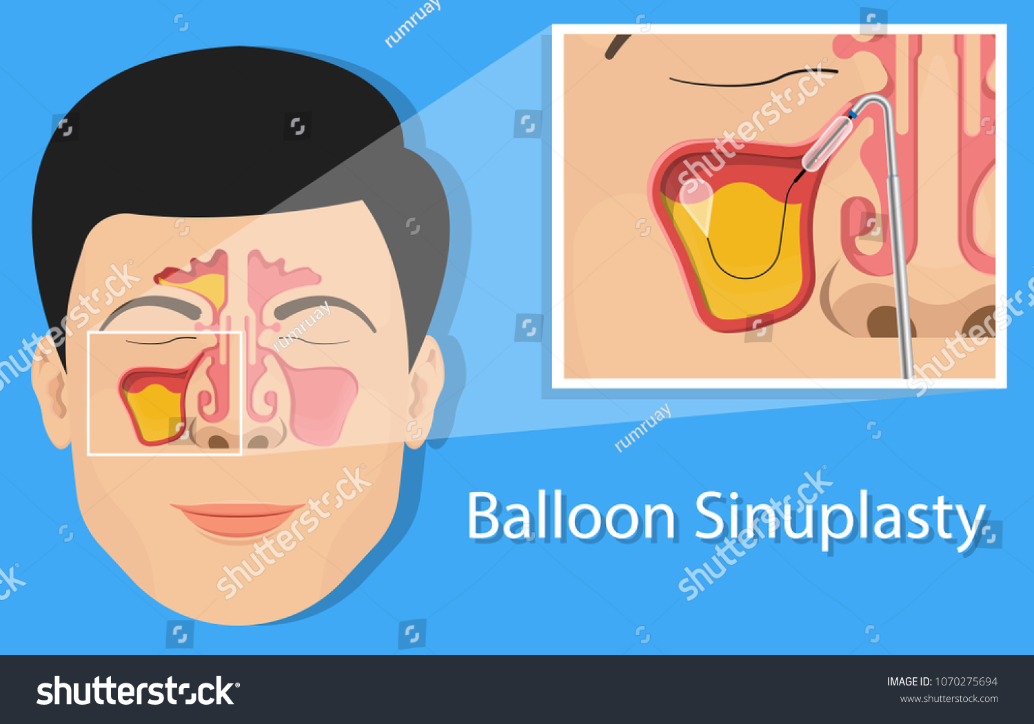 Sinusitis Medical Disease Treat Sinuses Allergies Stock Vector Royalty sinusitis-medical-disease-treat-sinuses-allergies-stock-vector-royalty
