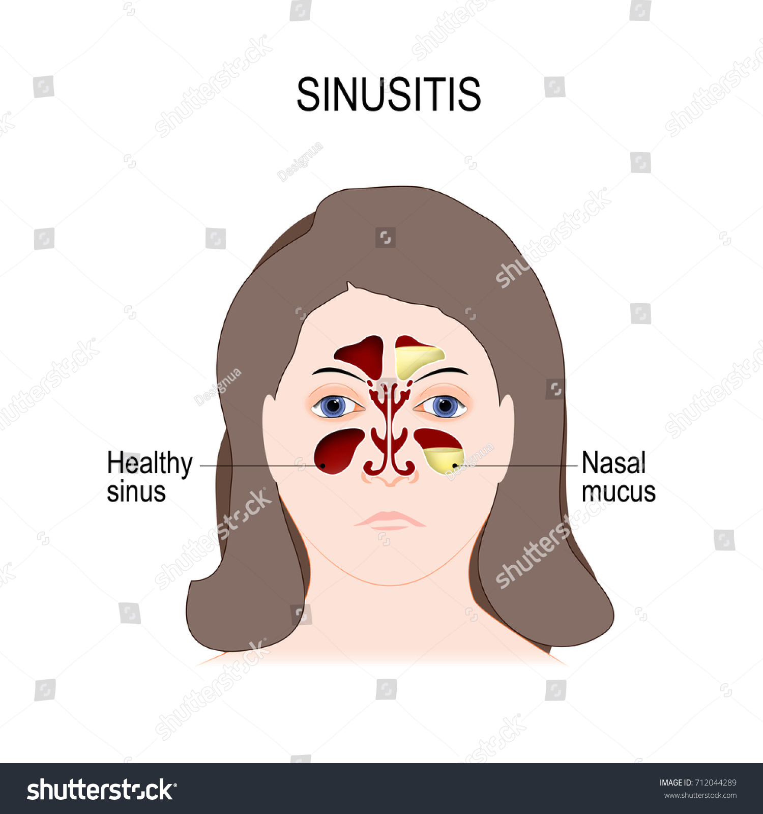 Sinusitis Sinus Infection Inflammation Sinuses Rhinosinusitis Vector