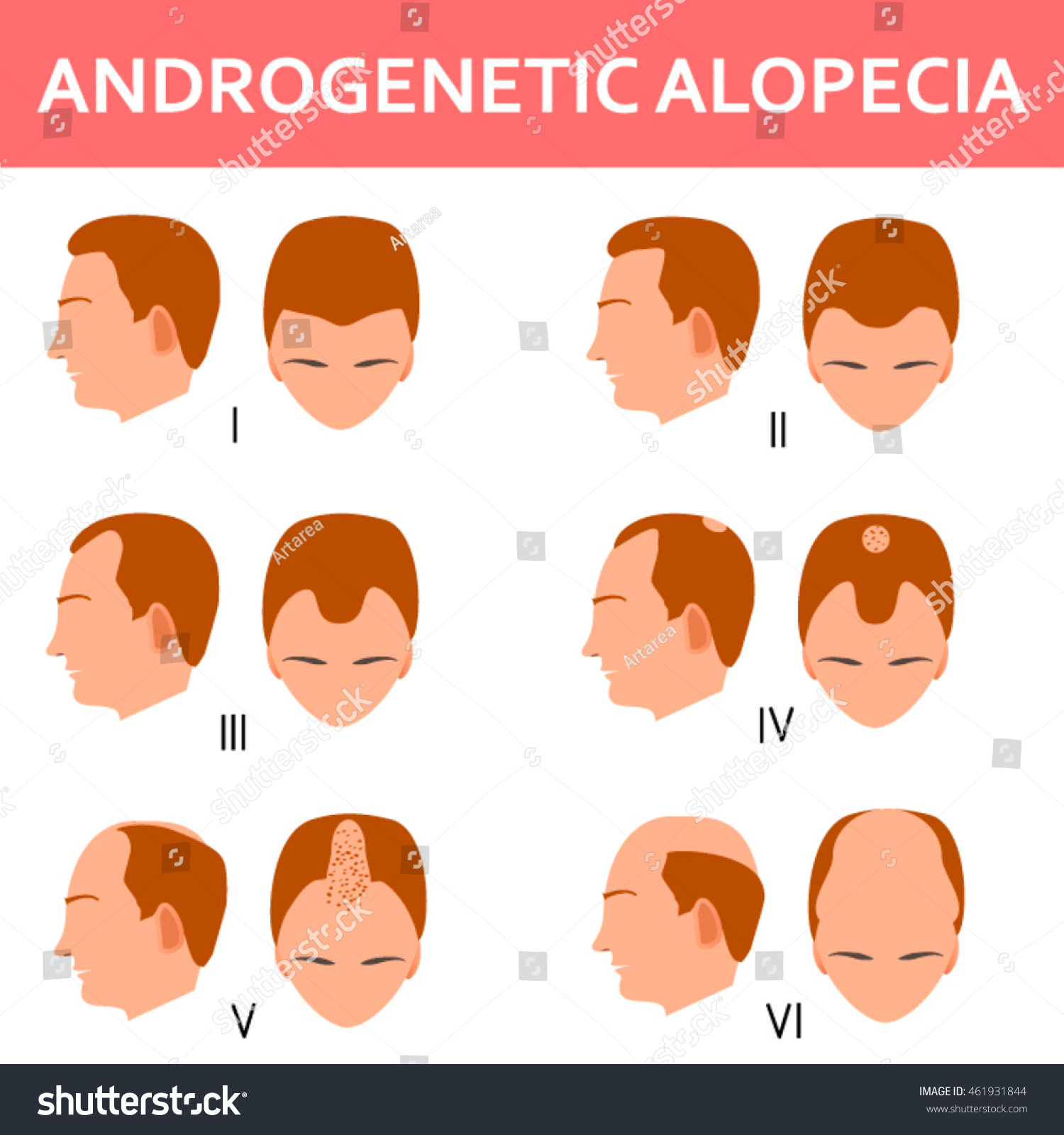 Six Stages Male Androgenetic Alopecia Vector Illustration 스톡 벡터(사용료 없음 ...