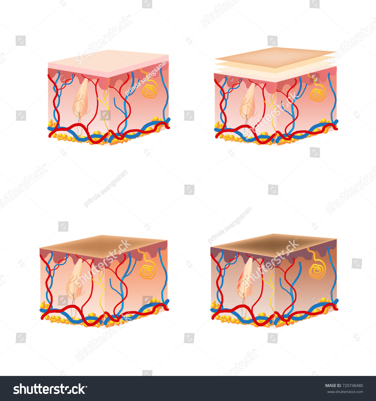 Skin Burn Classification First Second Third Stock Vector Royalty Free