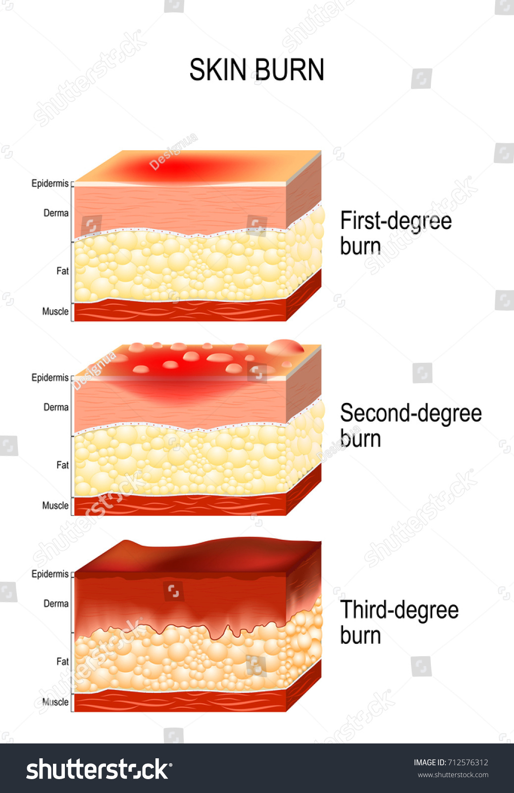 Skin Burn Three Degrees Burns Type Stock Vector 712576312 - Shutterstock