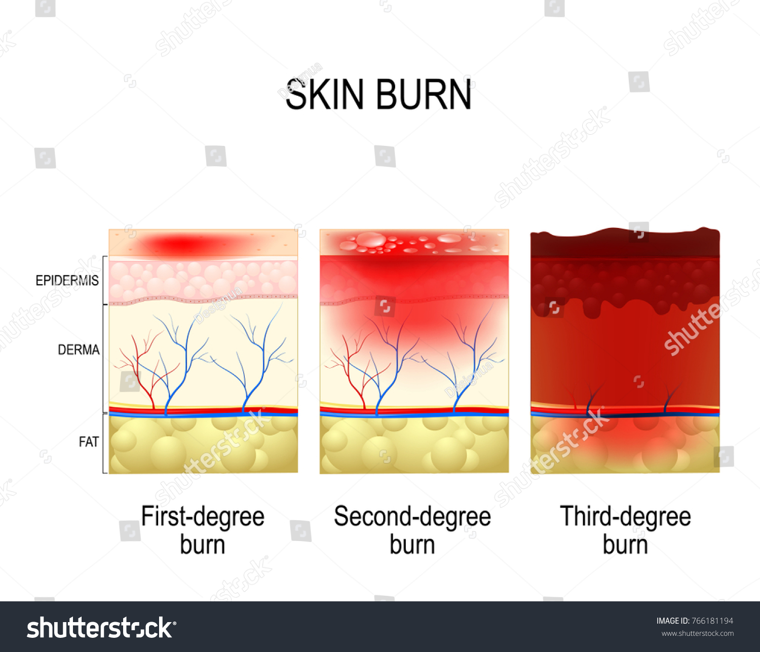 Vektor Stok Skin Burn Three Degrees Burns Type (Tanpa Royalti ...