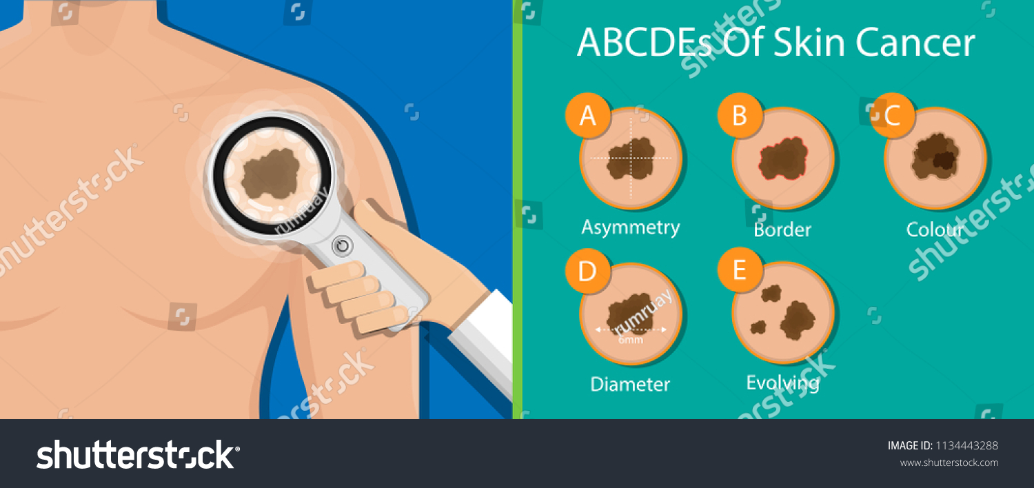 Skin Cancer Diagnosis Dermatology Screening Examination Stock Vector