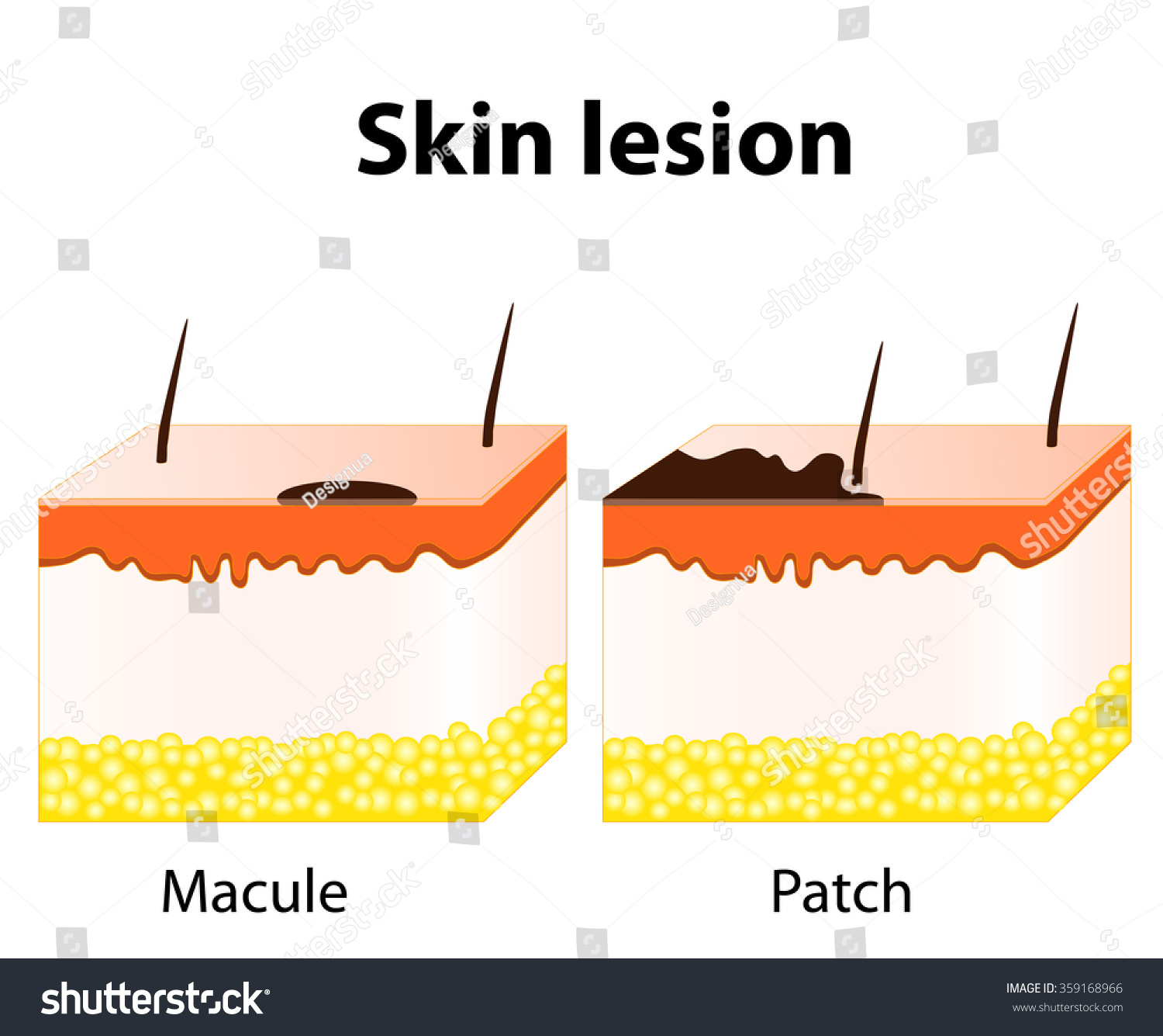 Skin Lesion. Macule Is A Change In Surface Skin Color, Without ...