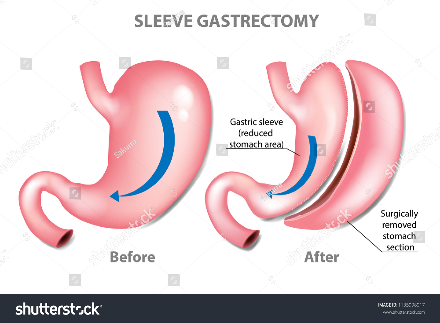 Sleeve Gastrectomy Weight Loss Surgery Before Stock Vector (Royalty ...