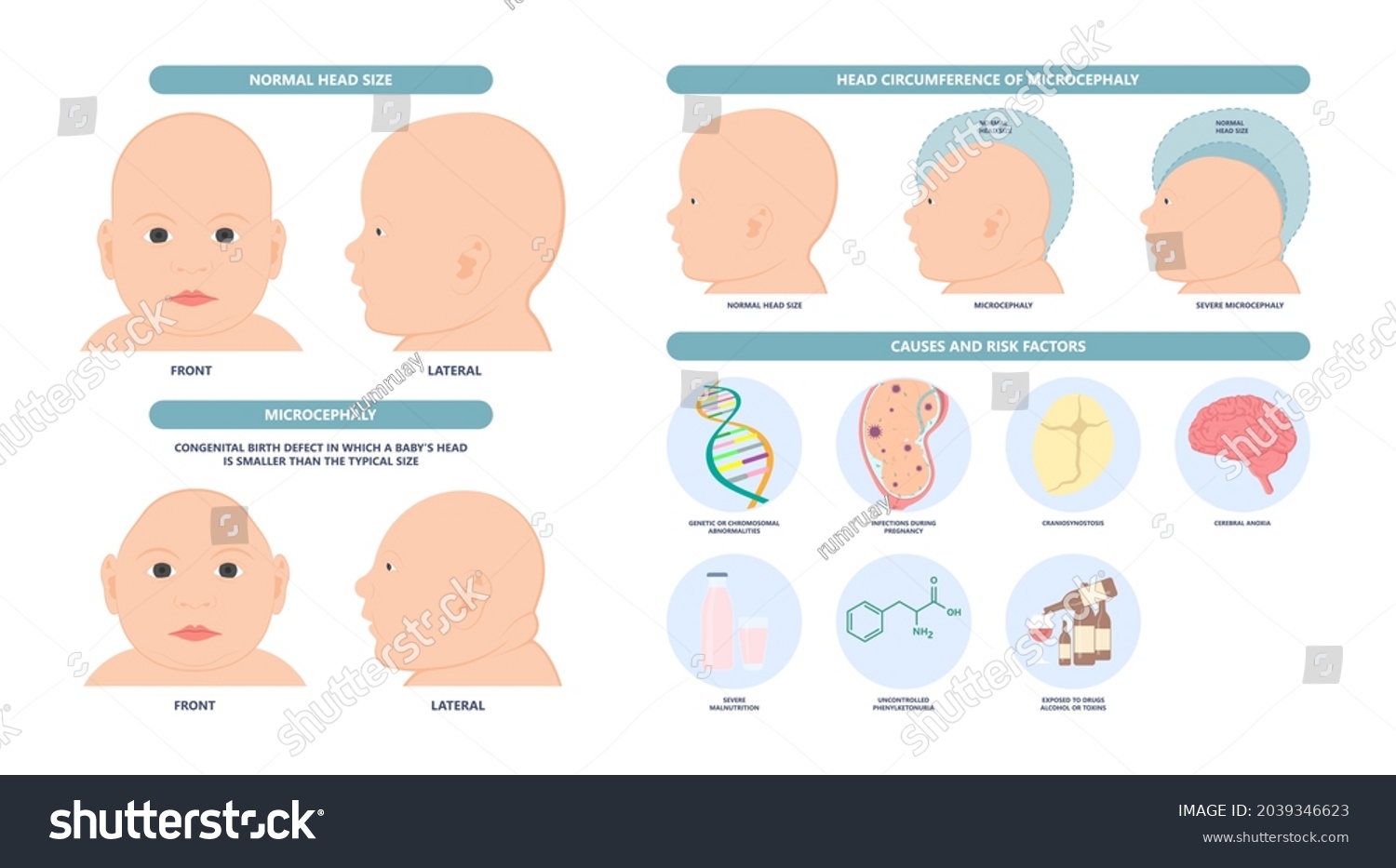 SVG of small head zika virus down autism birth defect baby brain infant fetus major severe speech Born gene toxic test genetic disease mutation DNA measure size fetal anoxia drug flat risk svg