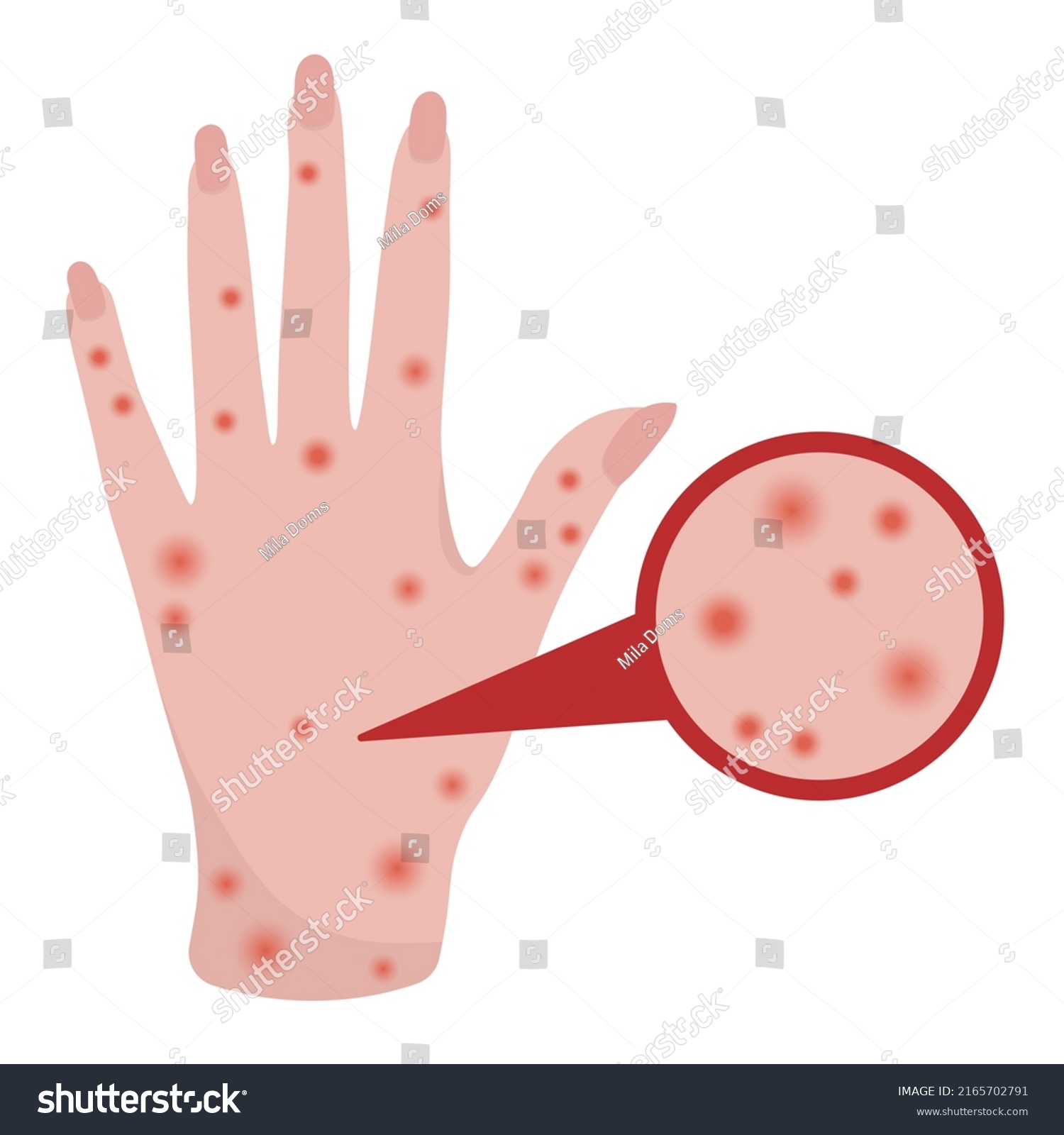 Smallpox Virus Vector Illustration Smallpox Virus Stock Vector (Royalty ...