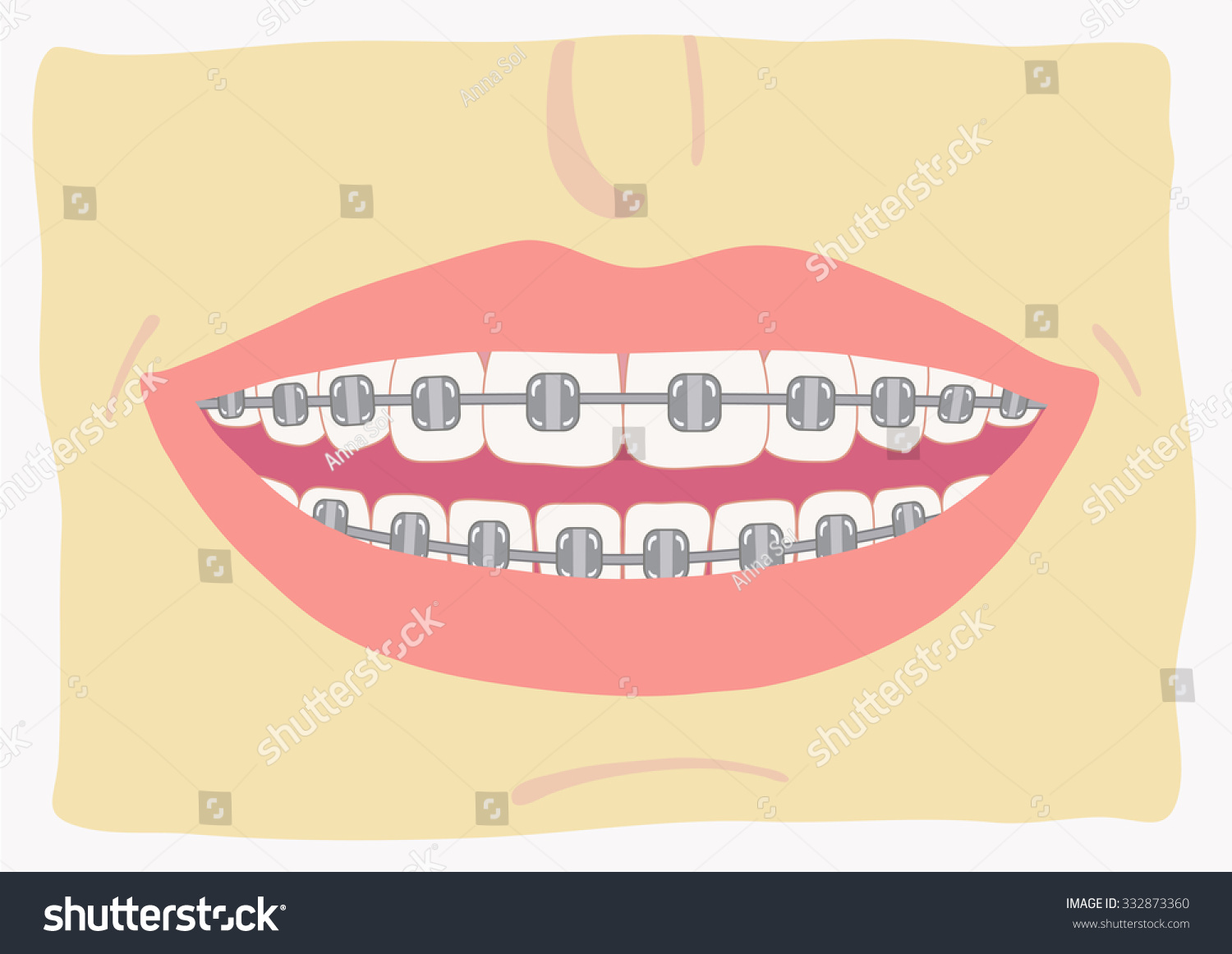 Smile With Braces On Teeth Vector Illustration , Flat Style. Dentist ...