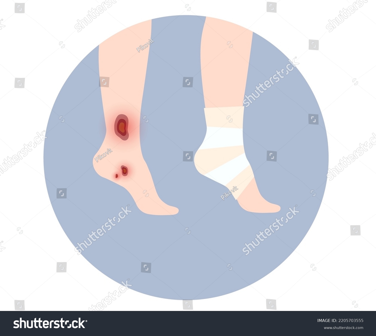 SVG of Sore, cut or ulcer on human leg. Elastic bandage, wrap medical gauze over foot. Healthcare concept. First help with injured ankle in a clinic or hospital. Patient with trauma flat vector illustration svg