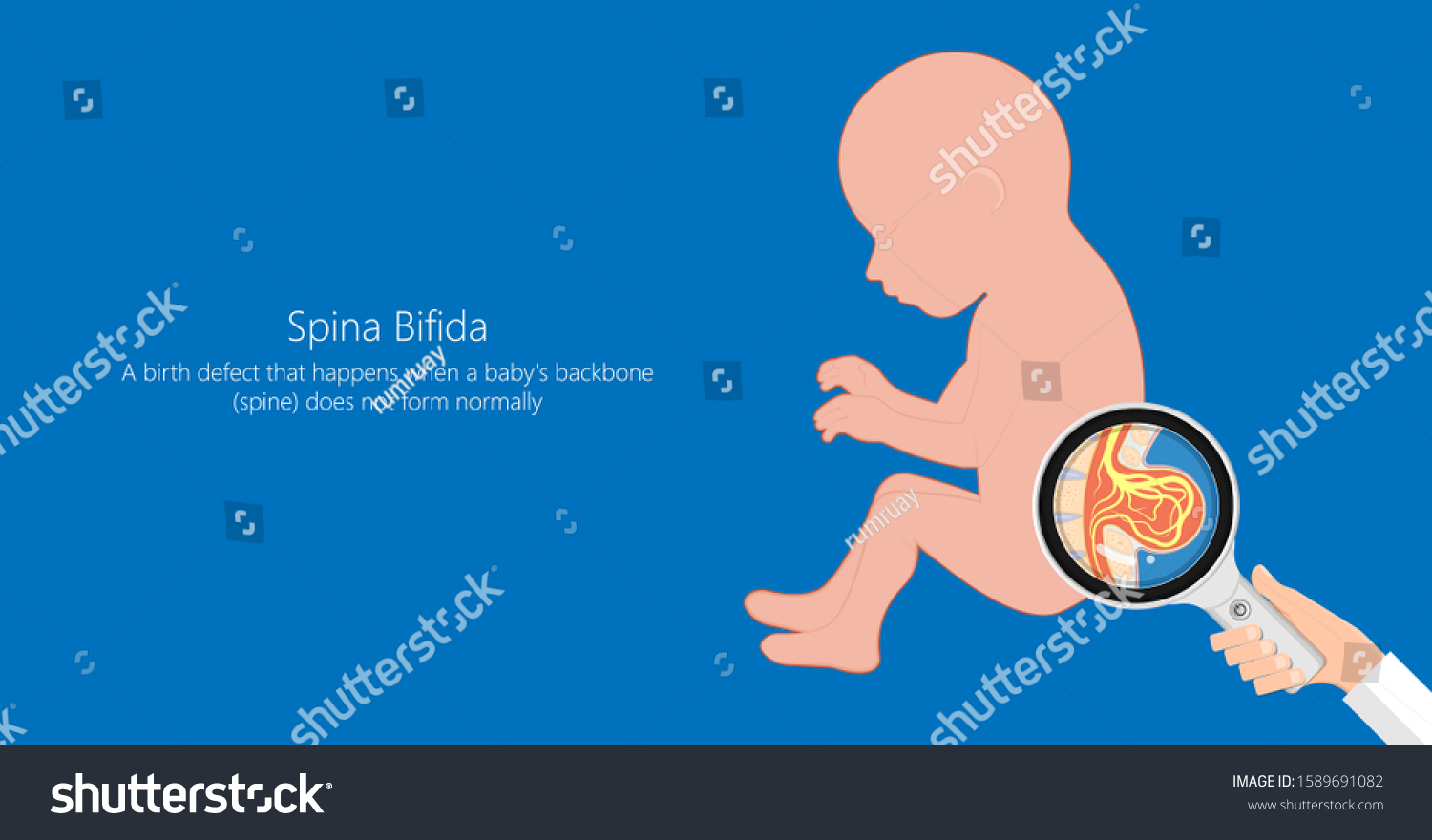 Spina Bifida Birth Defects Infant Disease Vector De Stock Libre De