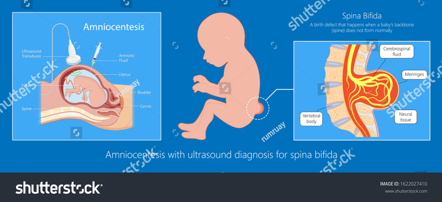 Spina Bifida Birth Defects Infant Disease Stock Vektor Royaltyfri 1622027410 Shutterstock 2475