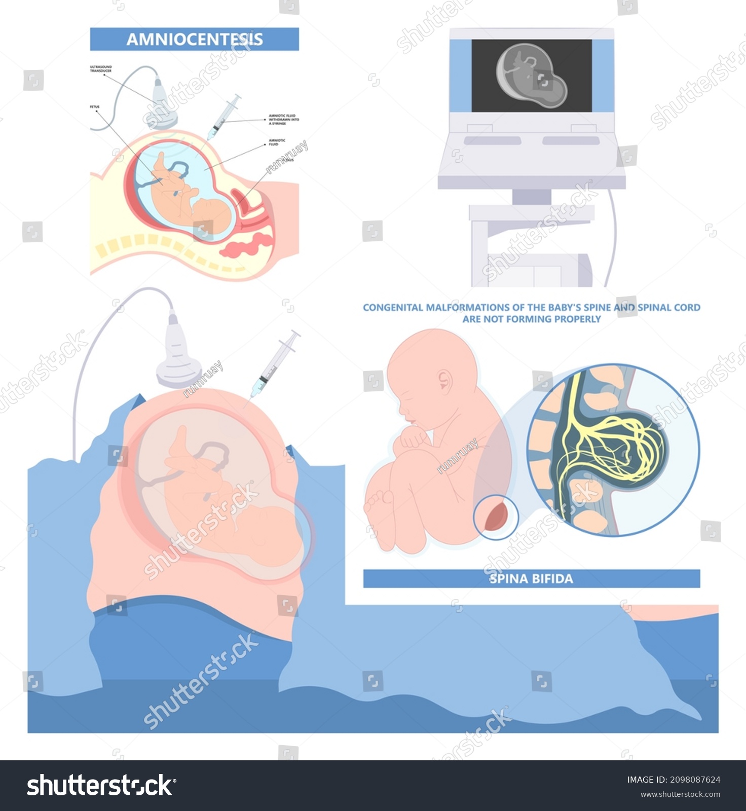 Spina Bifida Pregnancy Non Invasive Neural Stock Vector Royalty Free